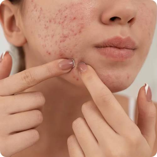 다크스팟 여드름 자국