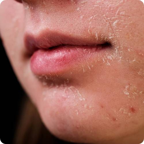 레티놀 부작용 퍼징