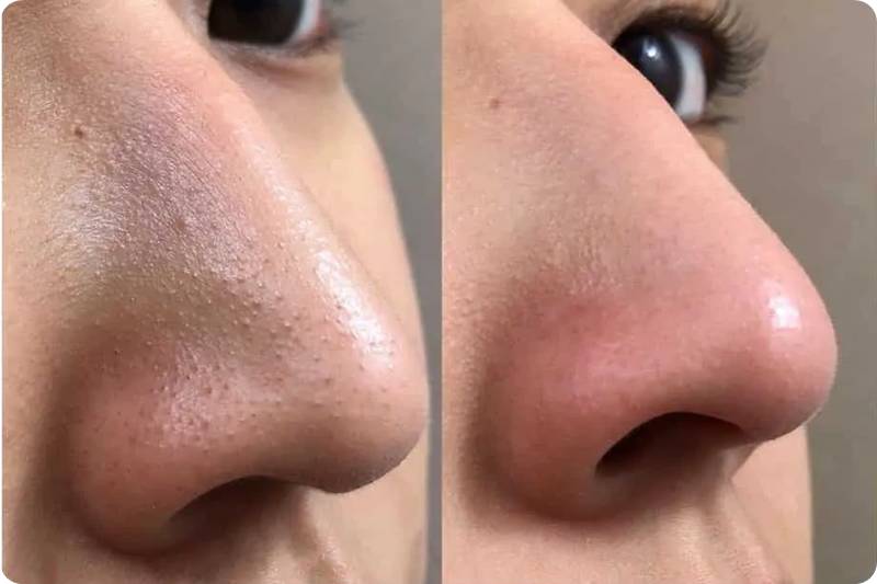 모공이 줄어든 전후 사진