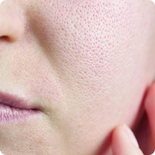 모공이 넓어지는 이유