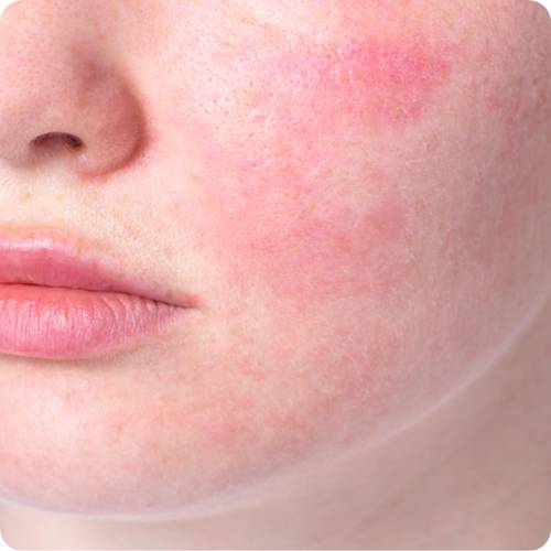 시술 후 재생크림