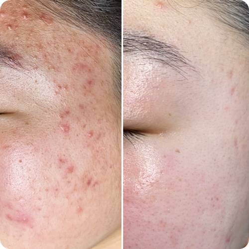 여드름 흉터 관리