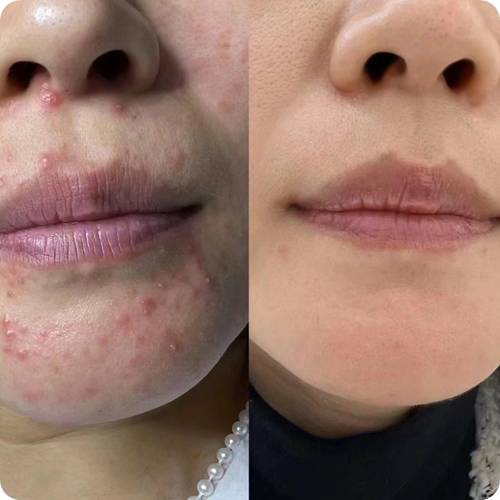 성인 여드름 전후 비교, 턱 주변 염증성 여드름 개선 모습 / Before and after comparison showing improvement in adult chin acne