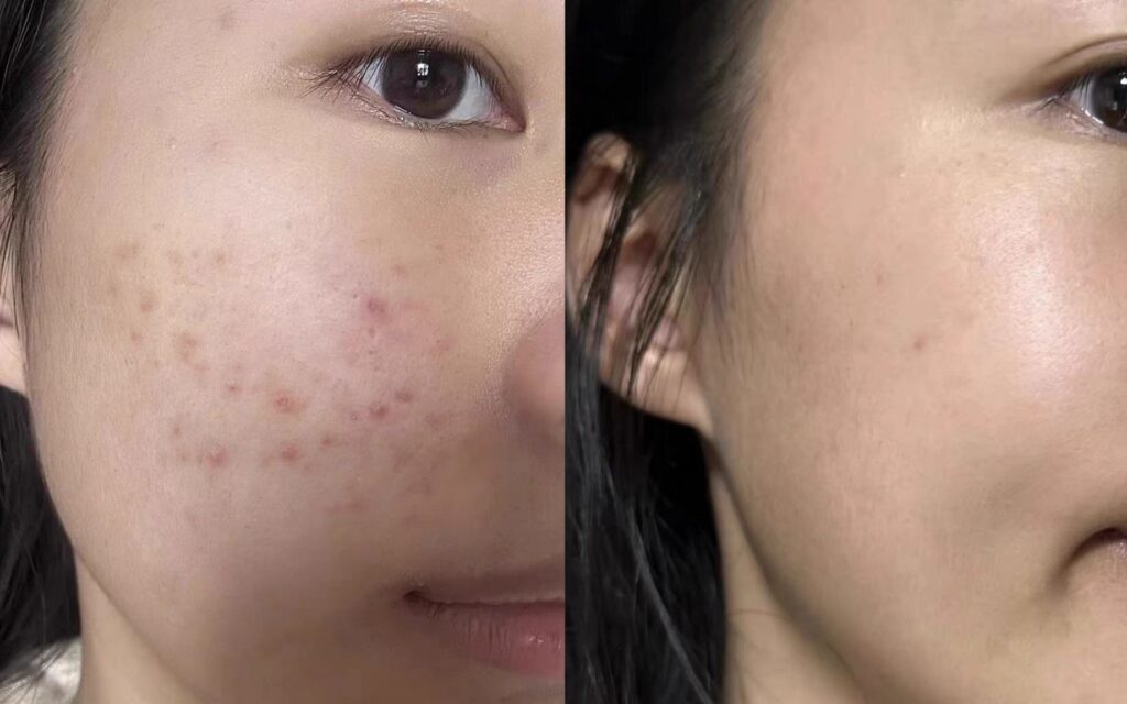 볼 부위 성인 여드름 전후 피부 변화 / Comparison of cheek acne before and after skin improvement in adults