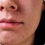 입 주변에 각질이 일어난 피부 장벽 손상 상태를 클로즈업한 이미지로, 지속적인 건조와 자극에 의해 약해진 피부 보호막을 표현한다. (Close-up of damaged skin barrier around the mouth showing dryness and irritation.)