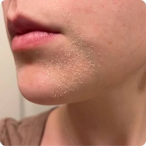 세라마이드 부족으로 인한 턱 주변 피부 건조와 각질 / Dry flaky chin caused by weakened skin barrier lacking ceramides