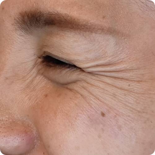 눈가 주름이 깊게 잡힌 상태, 주름 개선 전 피부 모습 / Deep eye wrinkles before treatment, showing aging skin texture