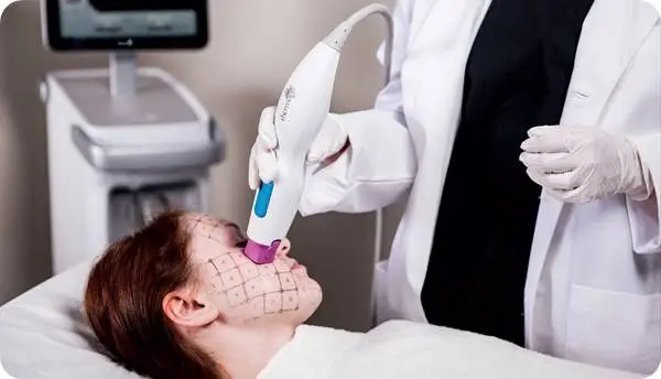 피부과 전문의가 여성의 얼굴 볼 부위에 써마지 고주파 리프팅 기기를 사용해 시술하는 장면. 얼굴에는 정교한 격자형 마킹이 표시되어 있으며, 환자는 편안히 누워 있는 상태에서 리프팅 시술을 받고 있다. (A dermatologist performing Thermage radiofrequency lifting on a woman’s cheek area, with grid markings visible on her face as she lies comfortably during the treatment.)