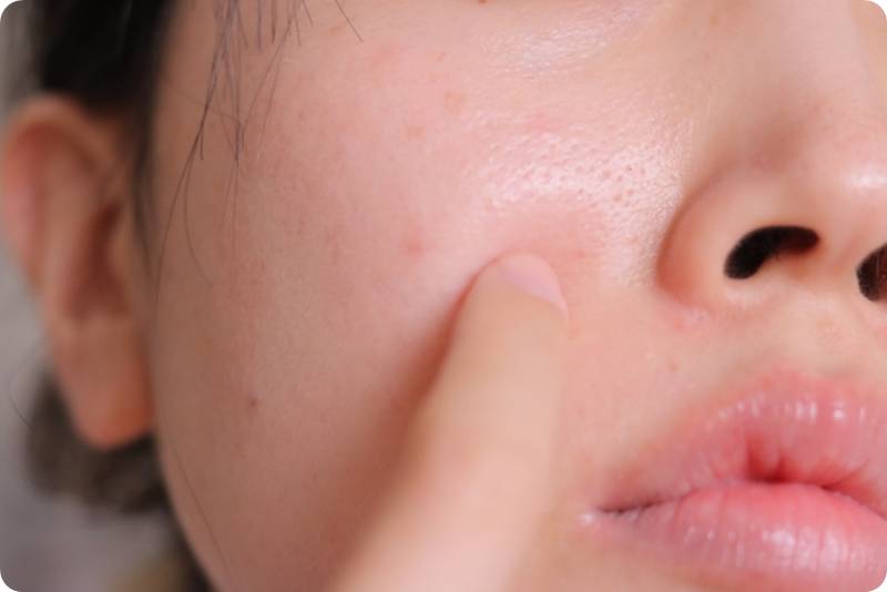 넓어진 모공을 많지는 여성