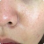 넓어진 모공 줄이기