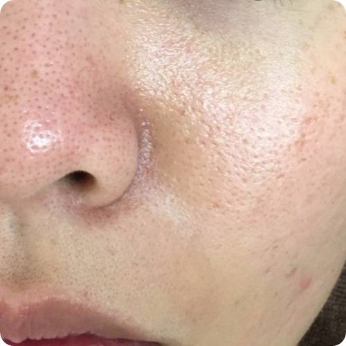 넓어진 모공 줄이기