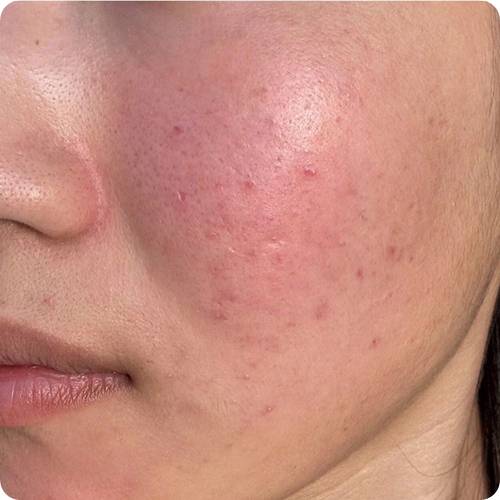 마데카소사이드로 진정이 필요한 붉은 여드름 피부 / Red acne-prone skin needing soothing care with madecassoside