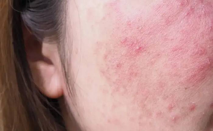 자극받은 민감성 피부의 붉은 염증 부위 / Irritated sensitive skin area showing redness before recovery